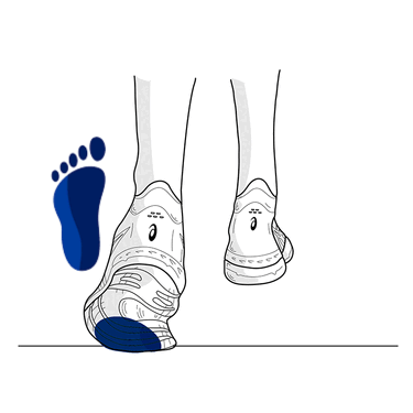 Overpronation - Flat Feet